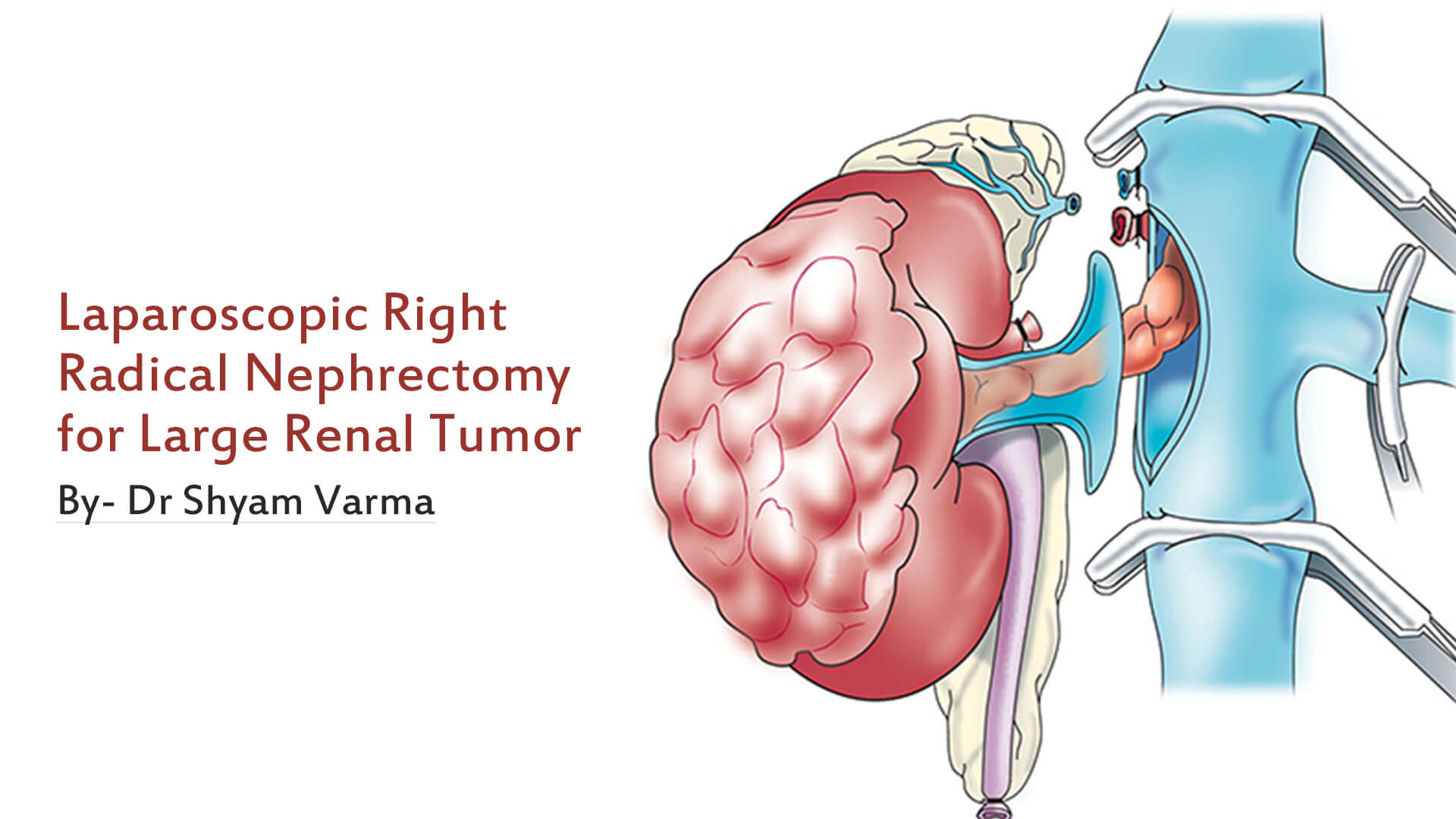 Laparoscopic Right Radical Nephrectomy for Large Renal Tumor (Vlog)